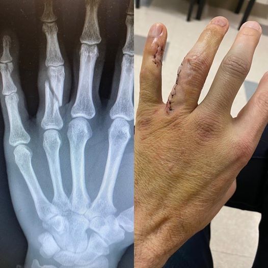 Le guitariste de Papa Roach, Jerry Horton, se casse les doigts et est remplacé par Anthony Esperance pour la tournée européenne 2020! 